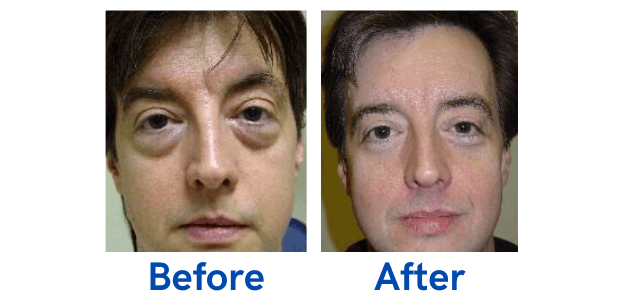 Lower Lid Blepharoplasty before and after photo