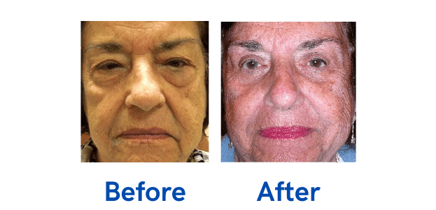 Ptosis + 4 Lid before and after photo