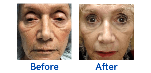 Ptosis + Upper Blepharoplasty before and after