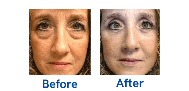 4 Lid Blepharoplasty before and after surgery