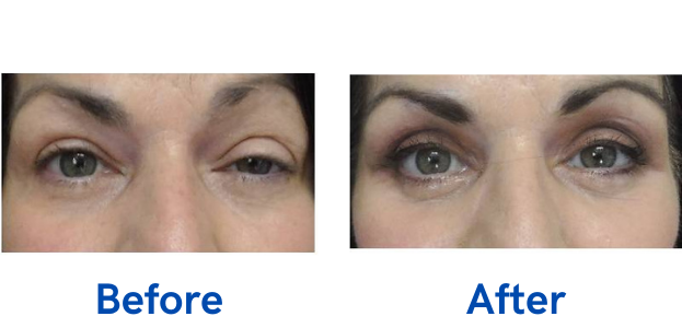before and after image of eyelid surgery