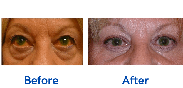 4 Lid Blepharoplasty before and after surgery