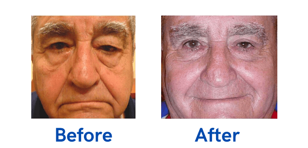 Ptosis + Upper Blepharoplasty before and after