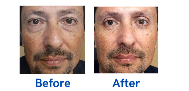 4 Lid Blepharoplasty before and after surgery