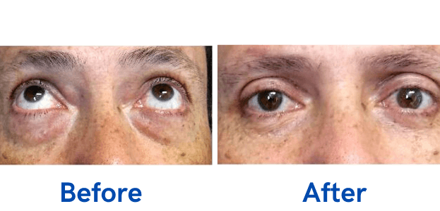 4 Lid Blepharoplasty before and after surgery