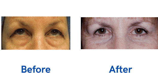 4 Lid Blepharoplasty before and after surgery