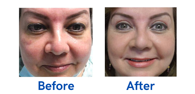 before and after image of eyelid surgery