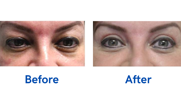 before and after image of eyelid surgery