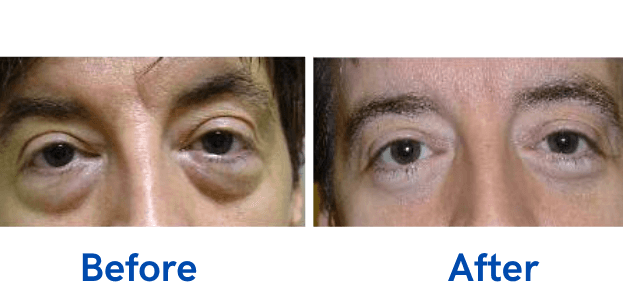 Lower Lid Blepharoplasty before and after photo