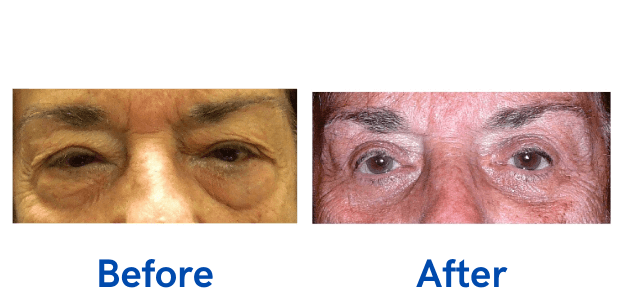 Ptosis + 4 Lid before and after photo