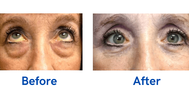 4 Lid Blepharoplasty before and after surgery