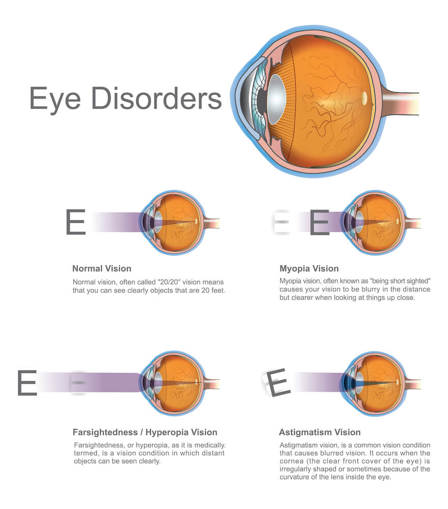 Eye disorders diagram