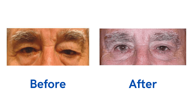 Ptosis + Upper Blepharoplasty before and after