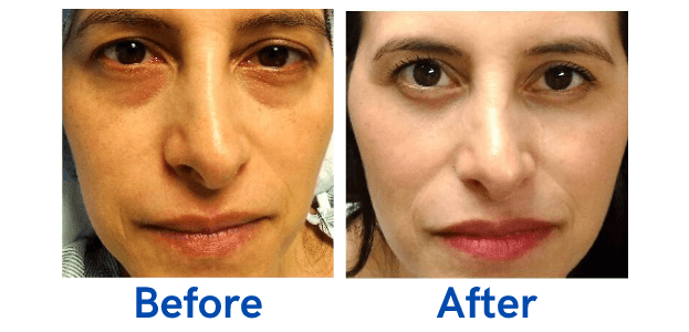 Lower Lid Blepharoplasty before and after photo