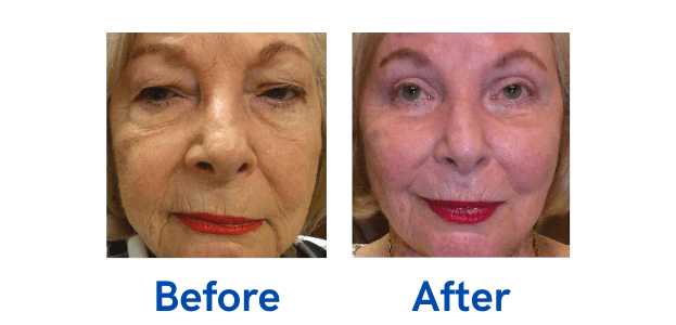Ptosis + 4 Lid before and after photo
