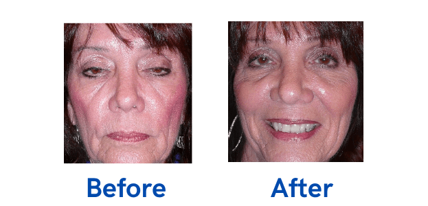 Ptosis + Upper Blepharoplasty before and after
