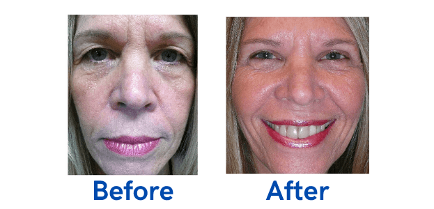 Upper Lid Blepharoplasty before and after