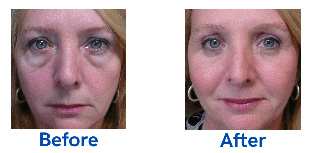 4 Lid Blepharoplasty before and after surgery