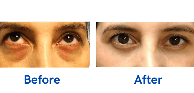 Lower Lid Blepharoplasty before and after photo