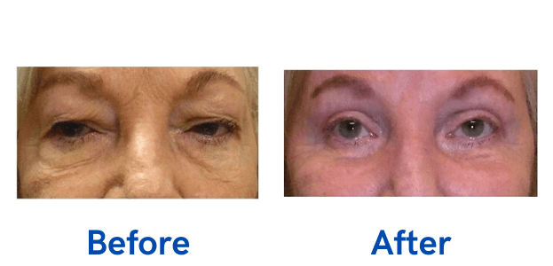 Ptosis + 4 Lid before and after photo