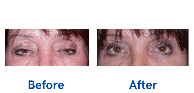 Ptosis + Upper Blepharoplasty before and after