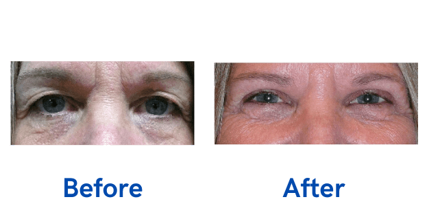 Upper Lid Blepharoplasty before and after