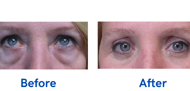 4 Lid Blepharoplasty before and after surgery