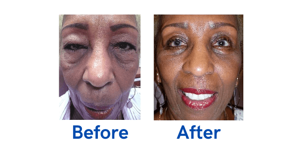 Ptosis + 4 Lid before and after photo