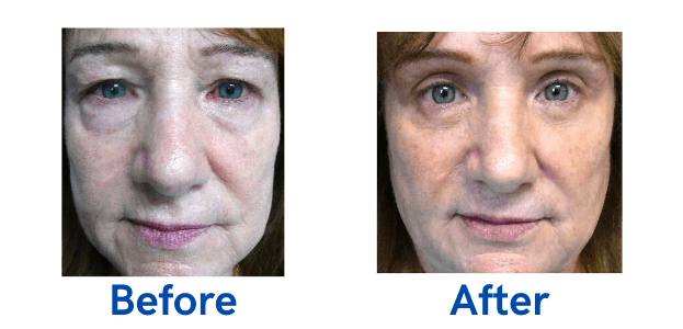 4 Lid Blepharoplasty before and after surgery