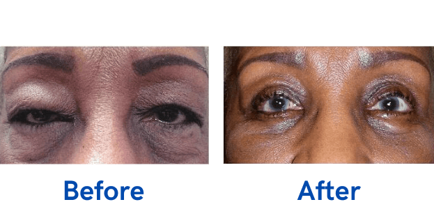 Ptosis + 4 Lid before and after photo