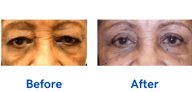 Ptosis + Upper Blepharoplasty before and after