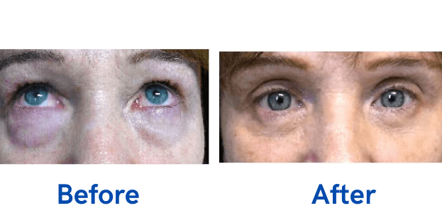 4 Lid Blepharoplasty before and after surgery