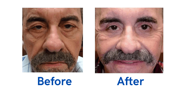 Ptosis + 4 Lid before and after photo