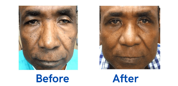 Ptosis + Upper Blepharoplasty before and after