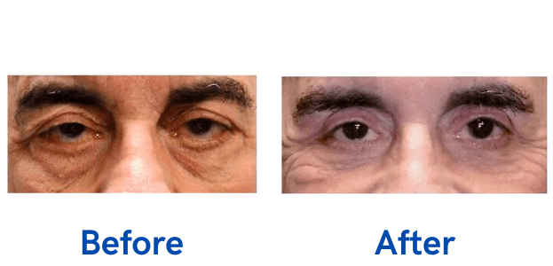 Ptosis + 4 Lid before and after photo