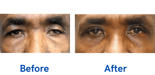 Ptosis + Upper Blepharoplasty before and after