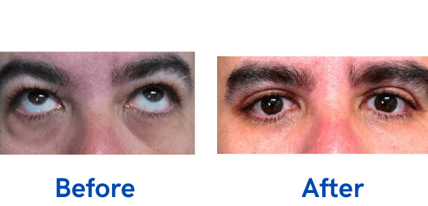 4 Lid Blepharoplasty before and after surgery