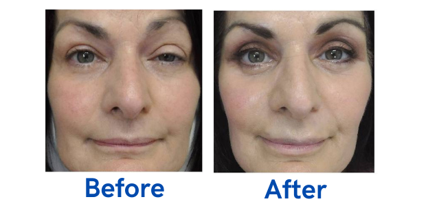 before and after image of eyelid surgery
