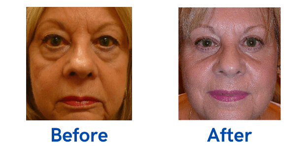4 Lid Blepharoplasty before and after surgery