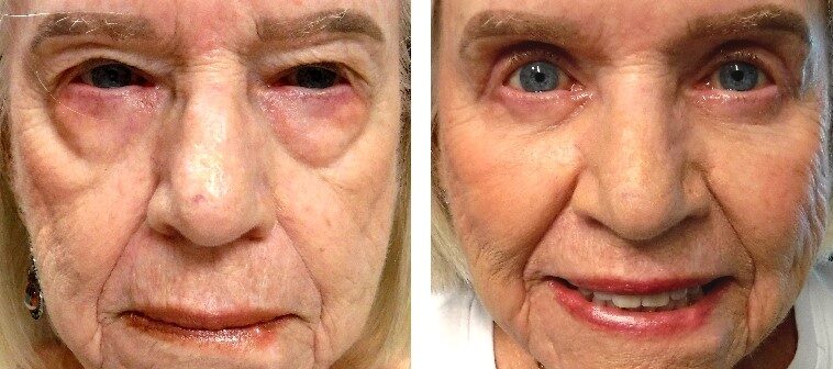 before and after photo upper lid blepharoplasty and ptosis