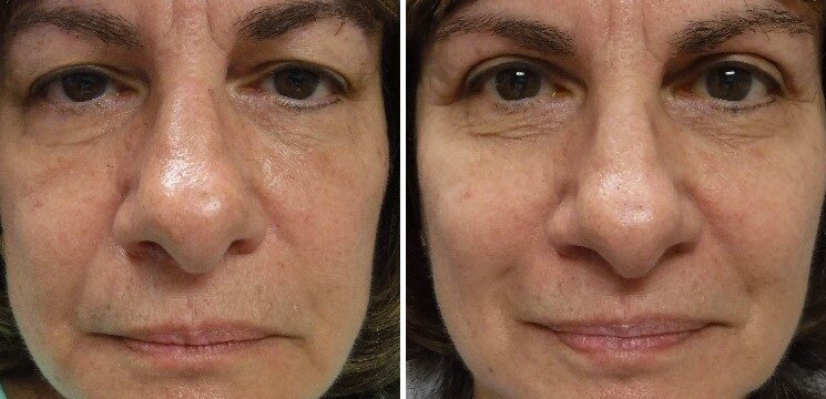 before and after photo upper lid blepharoplasty and ptosis