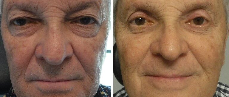 before and after photo four lid blepharoplasty and ptosis