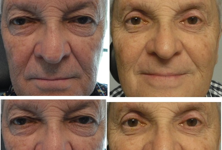 before and after photo four lid blepharoplasty and ptosis