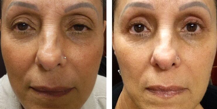 before and after photo upper lid blepharoplasty and ptosis