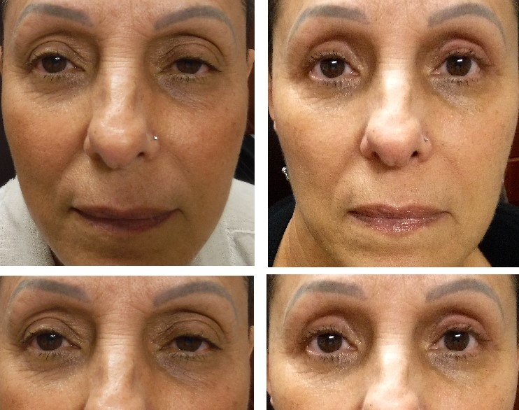 before and after photo upper lid blepharoplasty and ptosis
