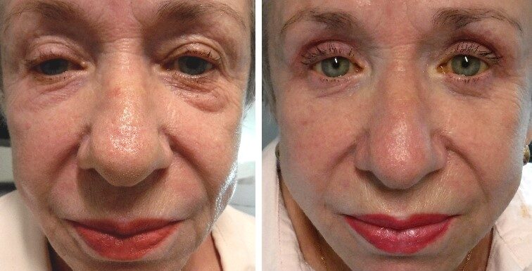 before and after photo four lid blepharoplasty and ptosis