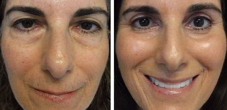 before and after photo four lid blepharoplasty and ptosis