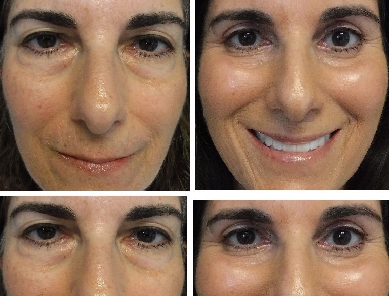 before and after photo four lid blepharoplasty and ptosis
