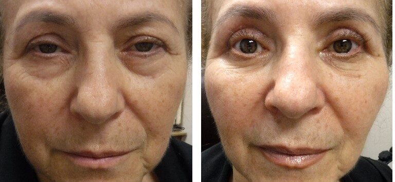 before and after photo four lid blepharoplasty and ptosis