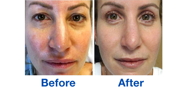 Before and after image of upper eyelid blepharoplasties
